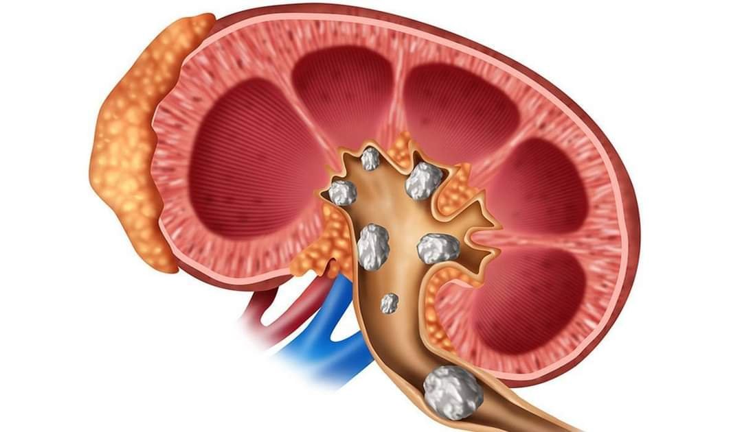 كيف تتشكل حصى الكلى في جسم الإنسان Baz News